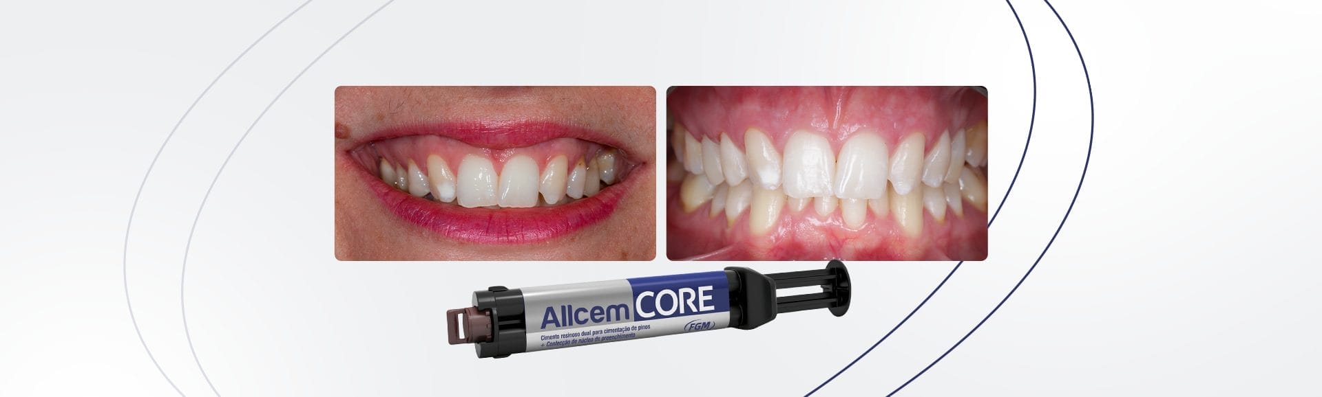 Rehabilitation with DC fit 0.4 fiberglass post and Allcem Core - FGMUS