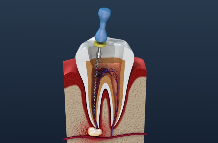 Blogs - Bang Box online - Common Root Canal Complications and How to Avoid Them