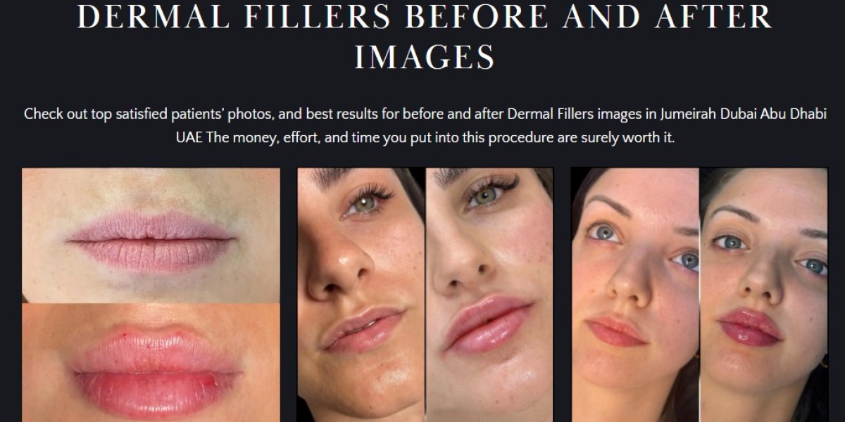 Why Go-To Destination for Dermal Fillers in Dubai 2024?