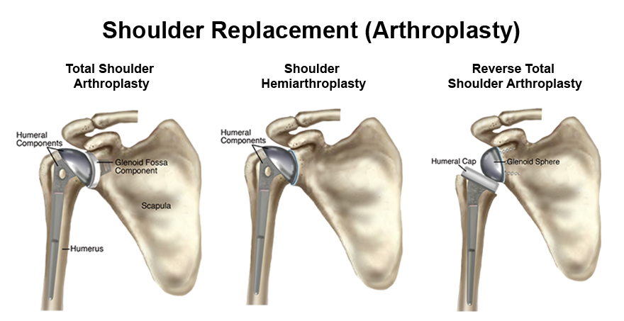 Shoulder Replacement Surgery in Faridabad | Dr. Naman Goel