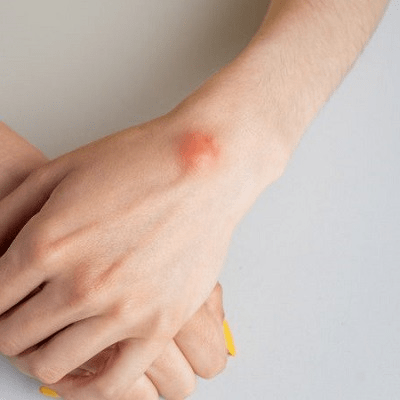 Scar Free Lipoma Surgery in Dubai & Abu Dhabi | Price & Cost