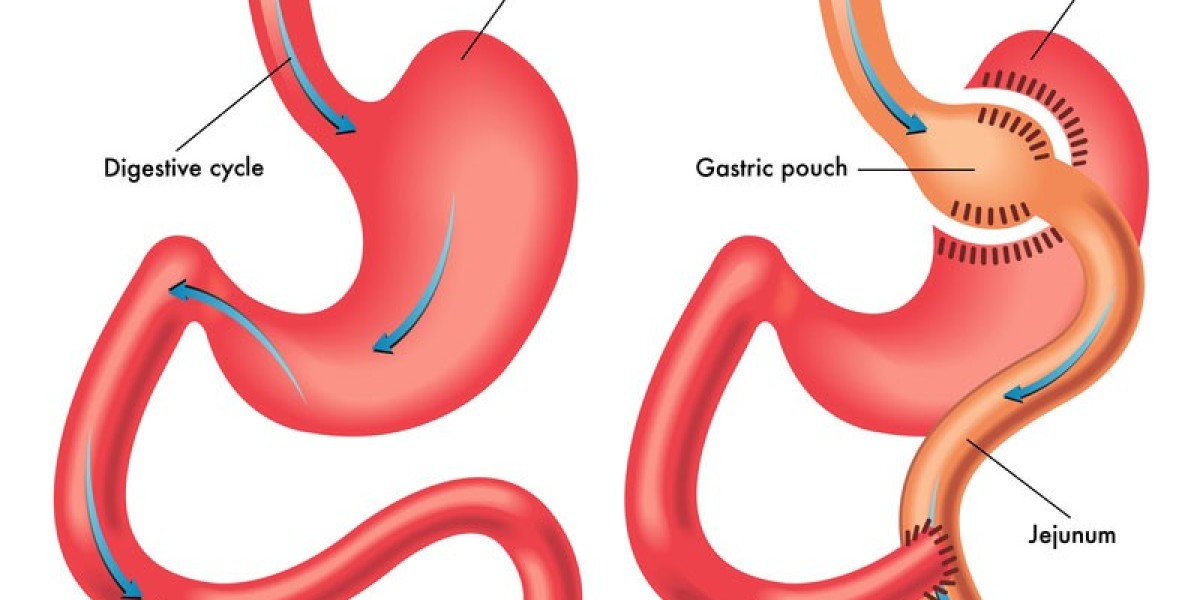 Affordable Gastric Bypass Surgery for Weight Loss in Pakistan