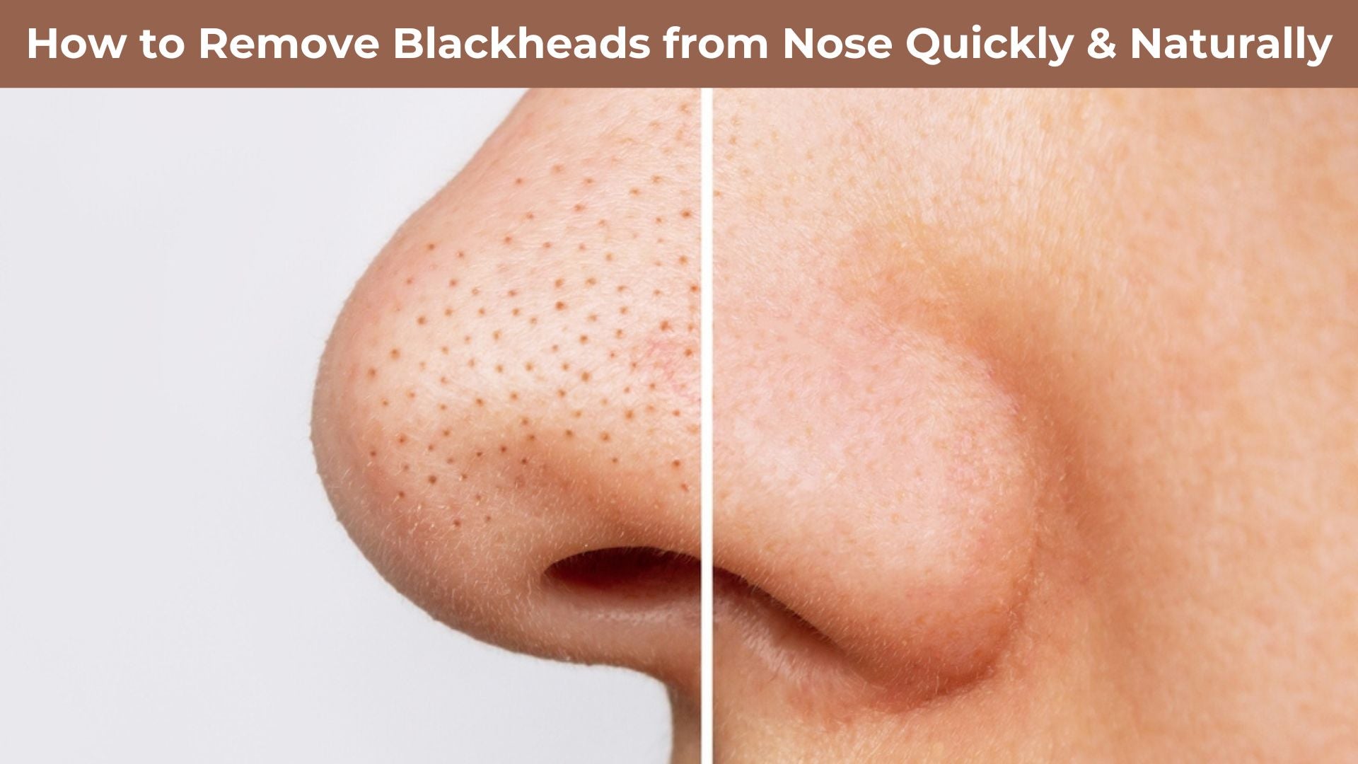 How to Remove Blackheads from Nose Quickly & Naturally