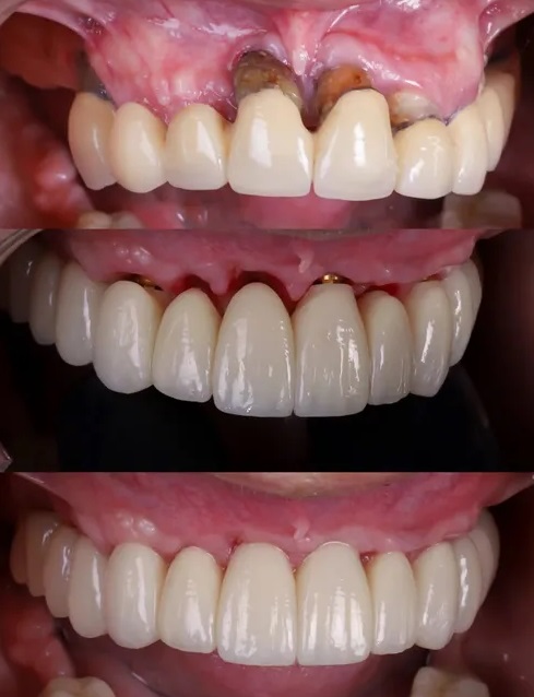 Implantes dentales sin hueso: sí es posible