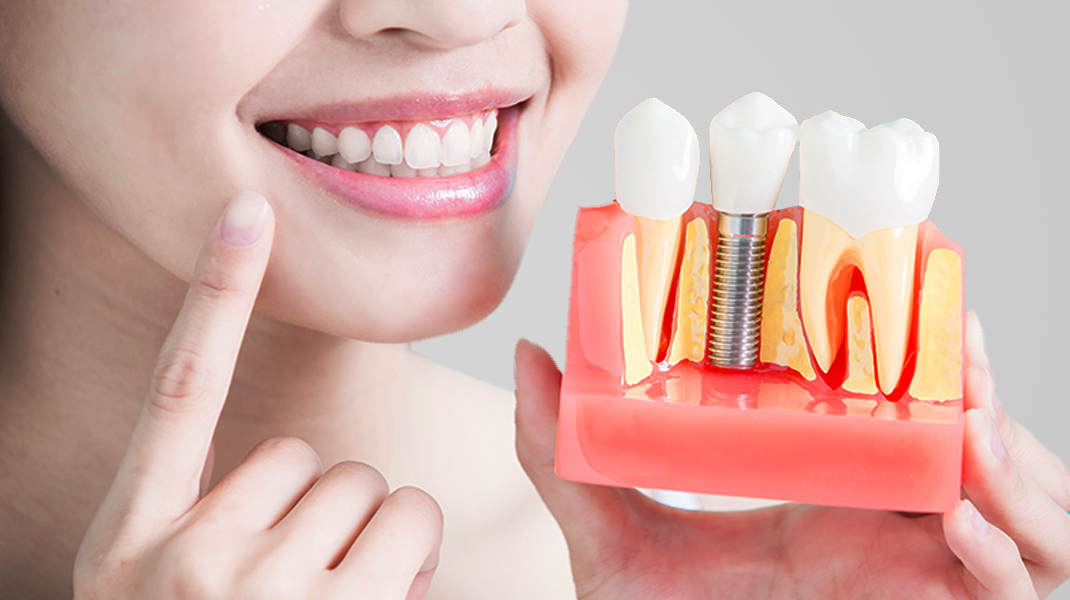 Dental implants in Ahmedabad | Tooth Replacement Procedure India