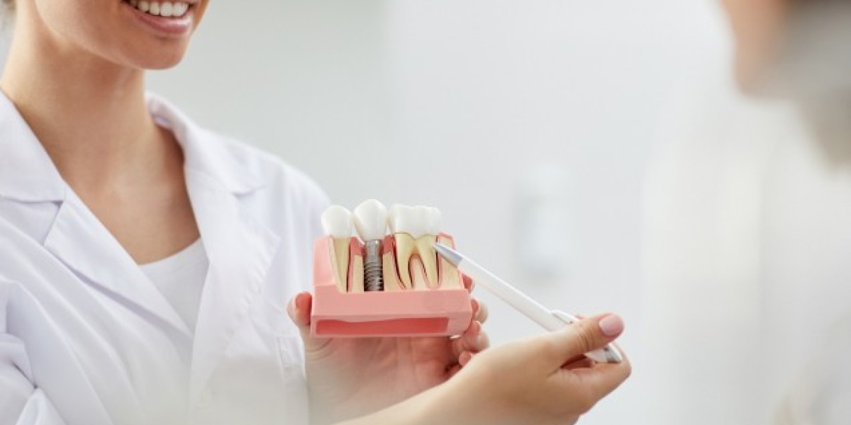 Beyond the Gaps: Why Dental Implants Are the Bees Knees in Surrey, BC