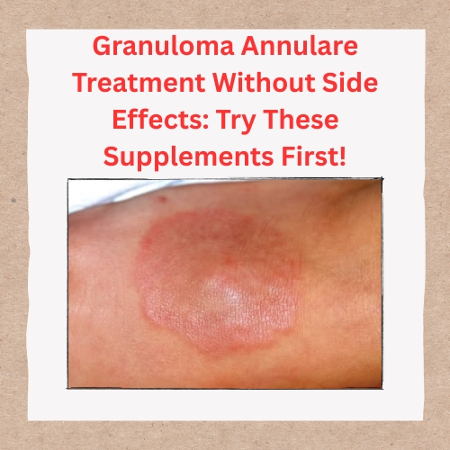 New PostGranuloma Annulare Treatment Without Side Effects: T – SmallBizBlog