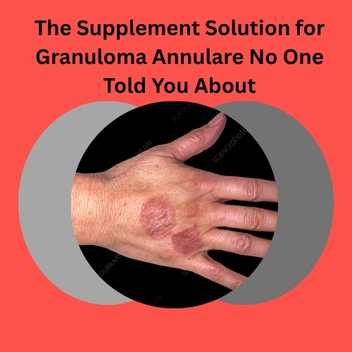 The Supplement Solution for Granuloma Annulare No One Told You About - ArticleWaves