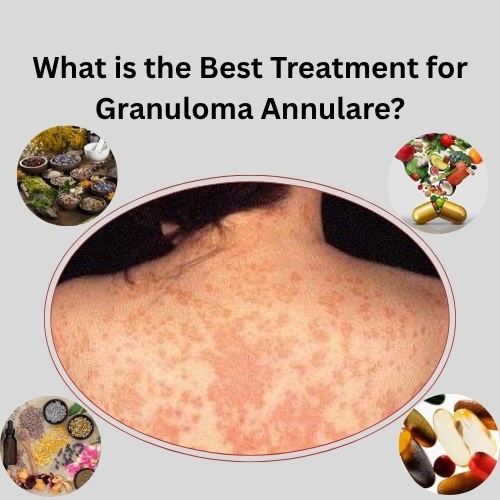 What is the Best Treatment for Granuloma Annulare? - Herbal Care Products - Blog