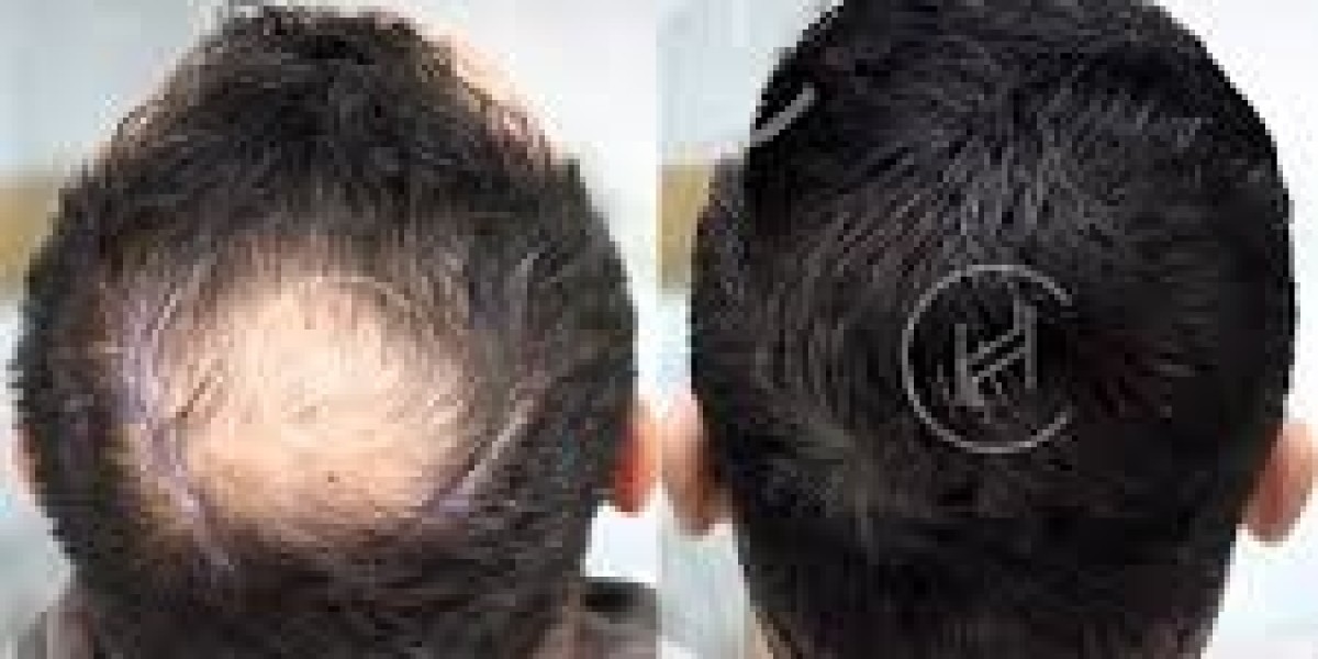 Before and After Photos of Hair Transplants That Will Motivate You