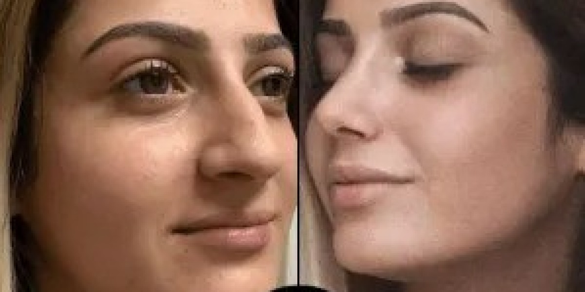 Why I Chose the Best Plastic Surgeon in Dubai