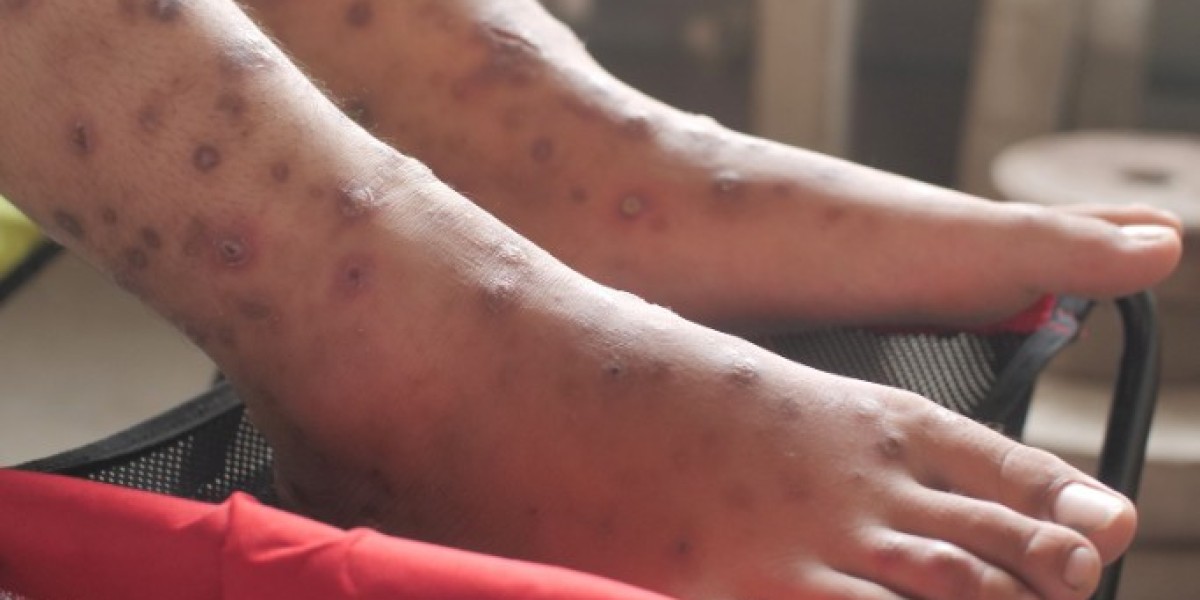 Understanding the 3 Common Types of Leg Ulcers: Venous, Arterial, and Diabetic