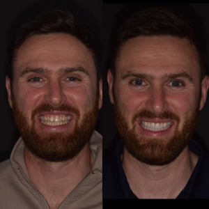 Invisalign in Macclesfield, Cheshire | Clear Braces Macclesfield