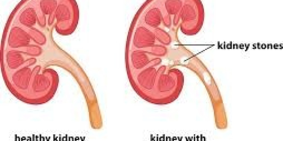 Kidney Stones Treatment: Expert Care at Urosonic
