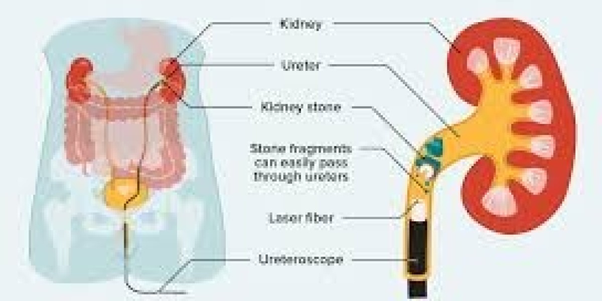 Say Goodbye to Stone Pain: Kidney Stone Laser Treatment & How to Choose the Right Kidney Stone Hospital