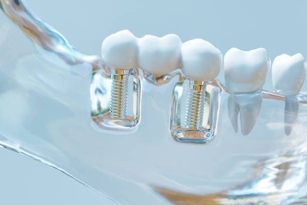 What Are Dental Implants? A Comprehensive Guide to Restore Smile