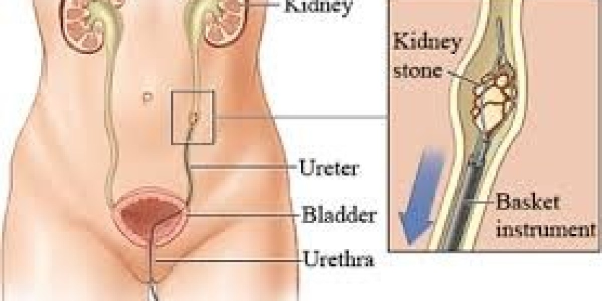 Choosing the Right Kidney Stone Hospital and Laser Treatment for Effective Care