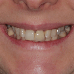 Dental Implants in Macclesfield, Cheshire - Fence House Dental