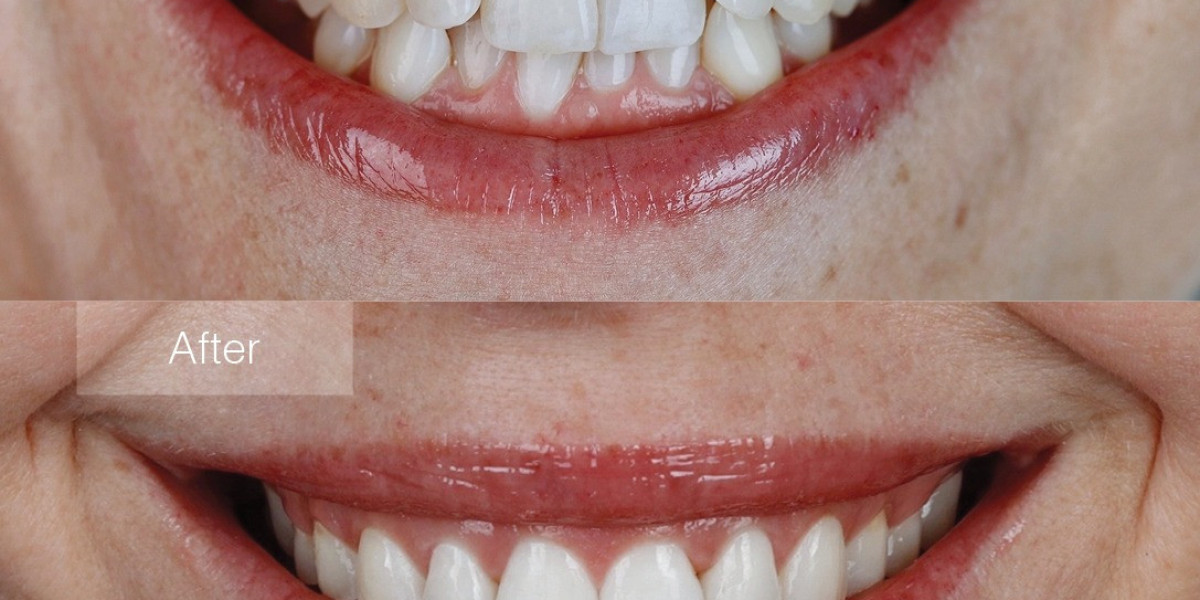 Overmoulding Parts: Enhancing Functionality and Aesthetics