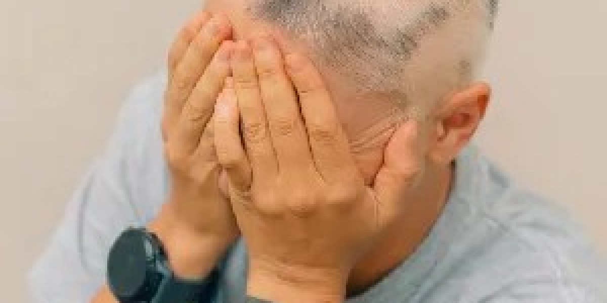 Alopecia Areata: What are Its Signs and Symptoms?