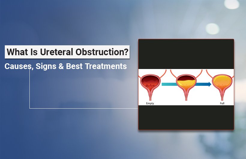 What Is Ureteral Obstruction? Causes, Symptoms & Treatments