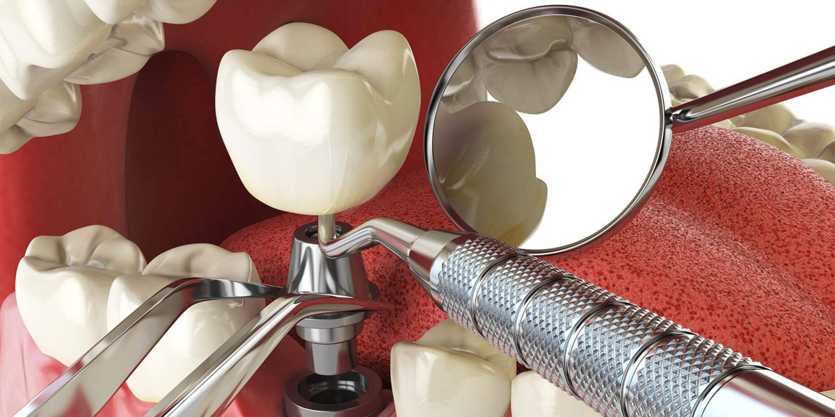 The Long-Term Health Benefits of Dental Implants in Glendale, AZ