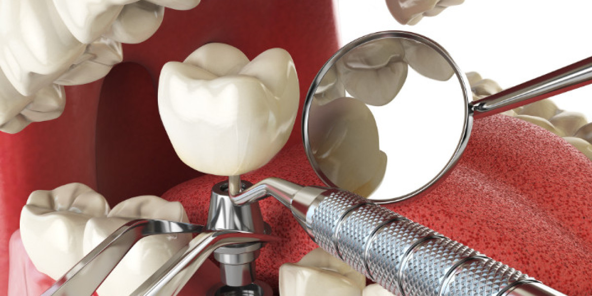 The Benefits of Getting Dental Implants Over Bridges