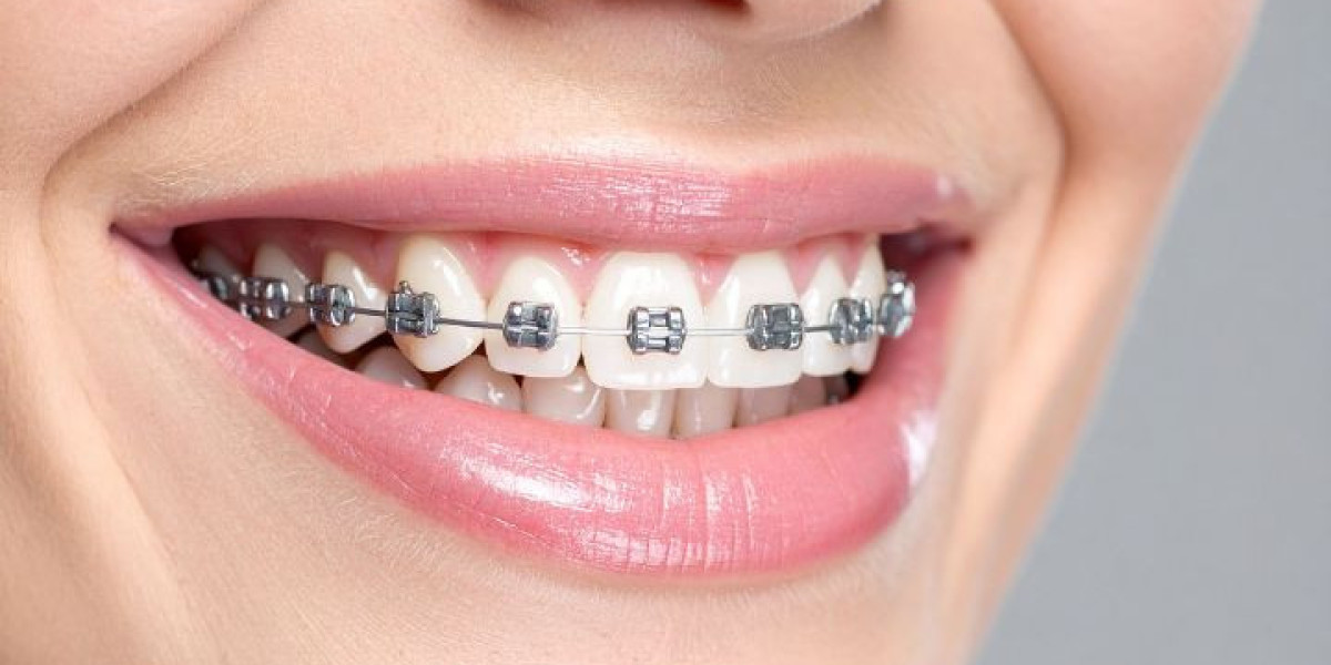 How to Recognise and Prevent Common Braces-Related Dental Issues