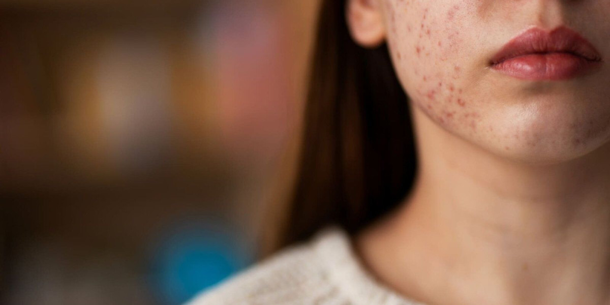 Experience Smooth Skin with Laser Hair Removal in Chandigarh