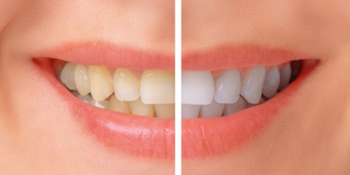 Get a Brighter Look with Teeth Whitening in North London
