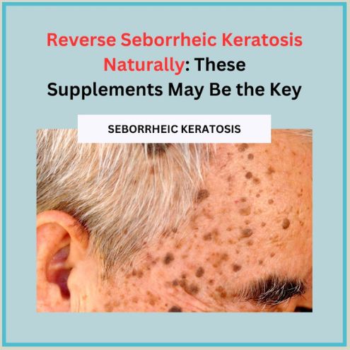 Reverse Seborrheic Keratosis Naturally: These Supplements May Be the Key - Natural Health News