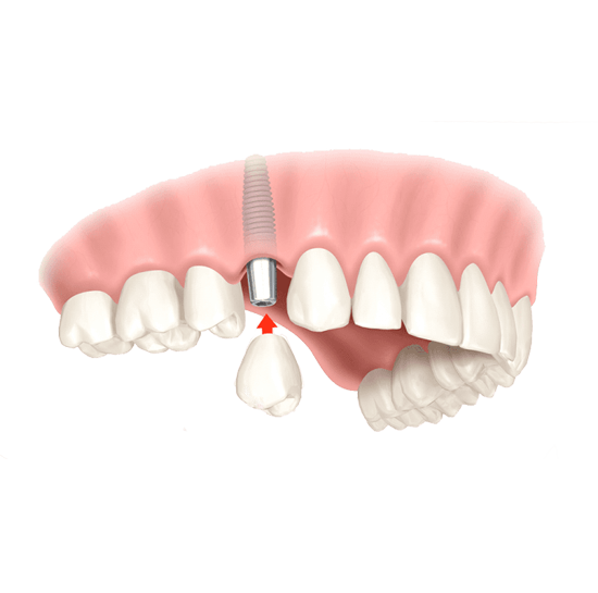 The Hidden Health Benefits of Choosing Dental Implants | by Smile White Dental Clinic | Sep, 2025 | Medium