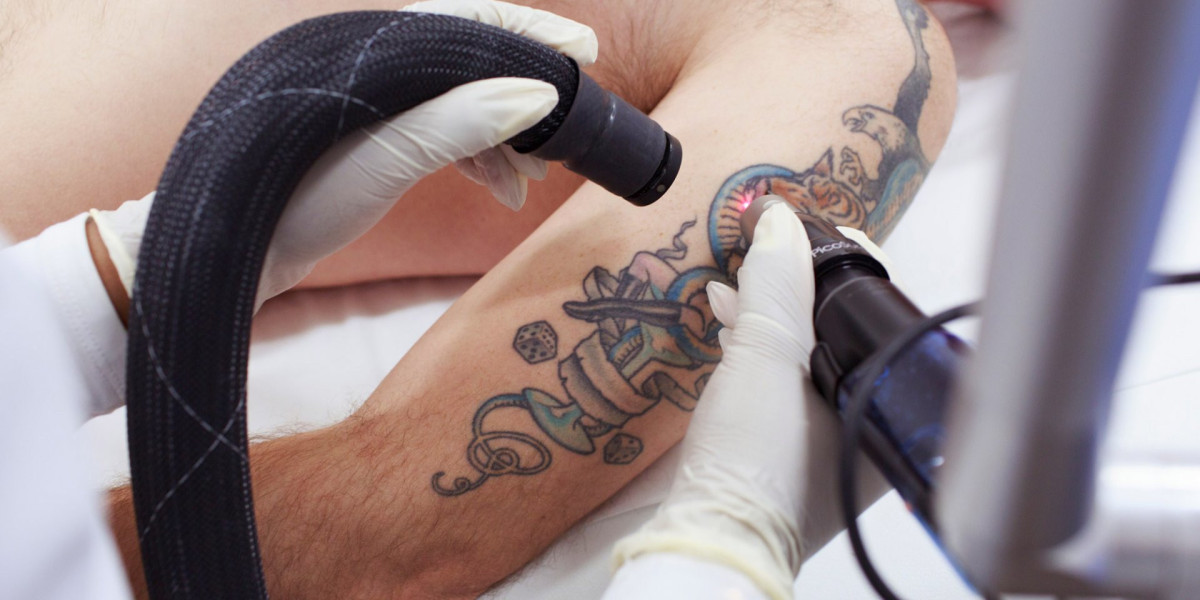 What Aftercare is Needed Following Tattoo Removal Sessions?