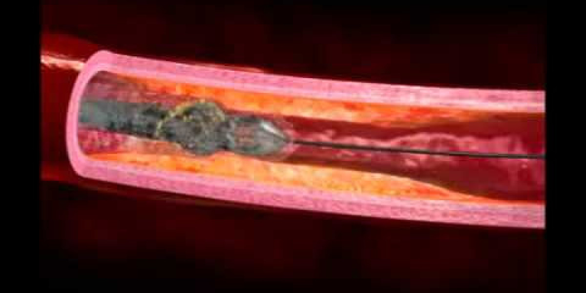 Atherectomy Devices Market Size, Trends, and Growth Forecast 2025-2032