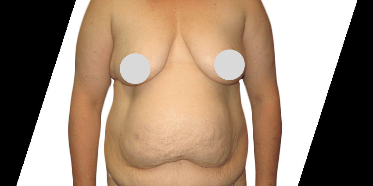 Things You Must Know Before Getting a Body Lift Procedure in Houston