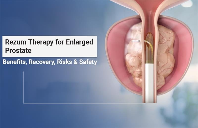 What is Rezum Therapy for Enlarged Prostate: Benefits & Risks