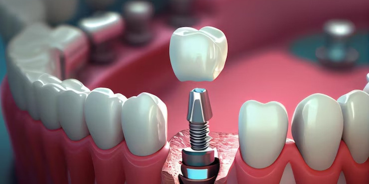 Discover the True Value of Dental Implants in Houston