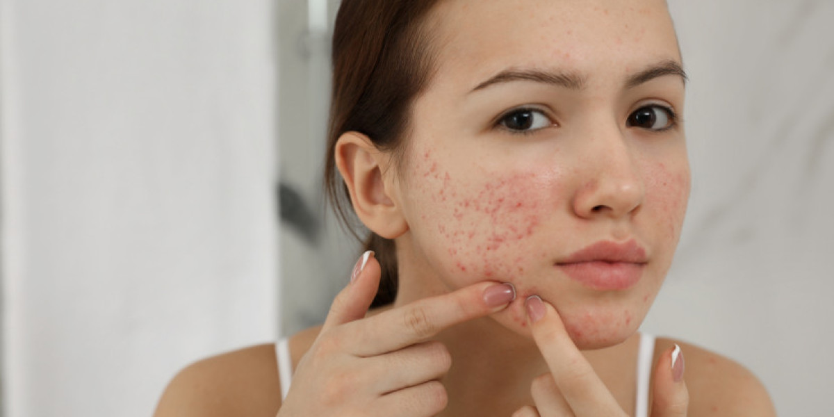 Acne Epidemiology Forecast 2025-2034