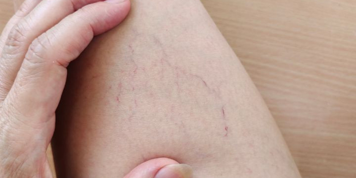 Are Varicose Veins More Common in Women Than Men?
