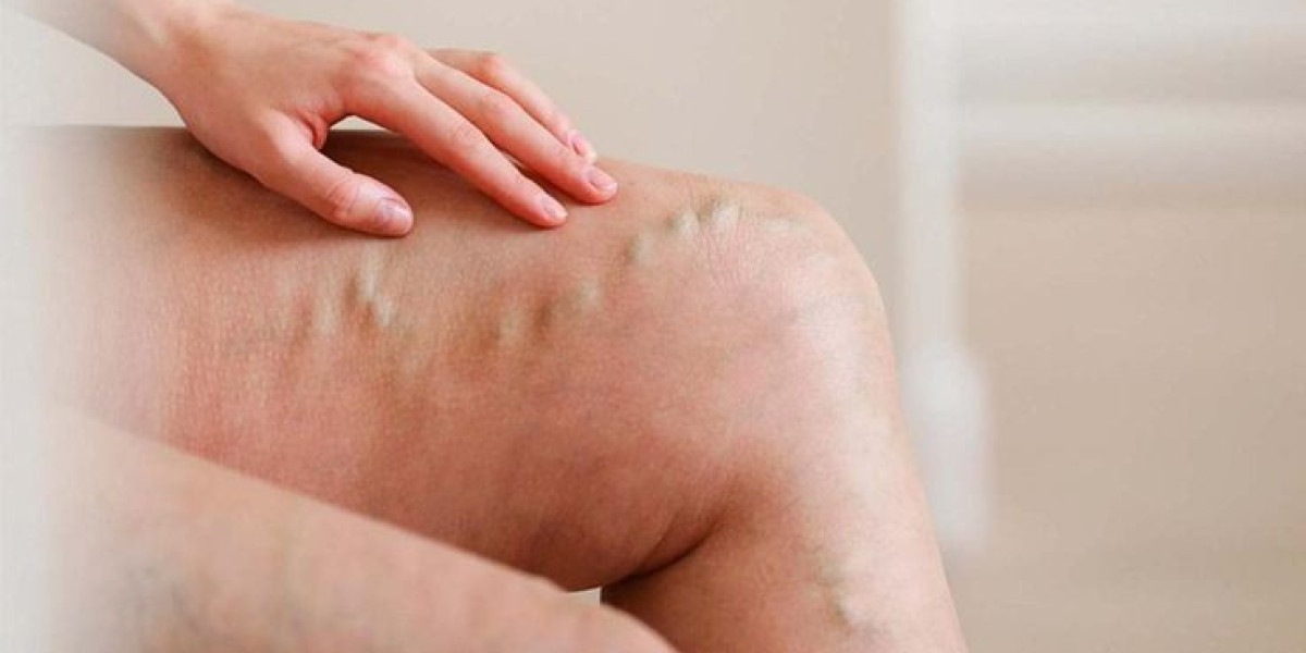 Are There New Minimally Invasive Procedures for Varicose Veins?