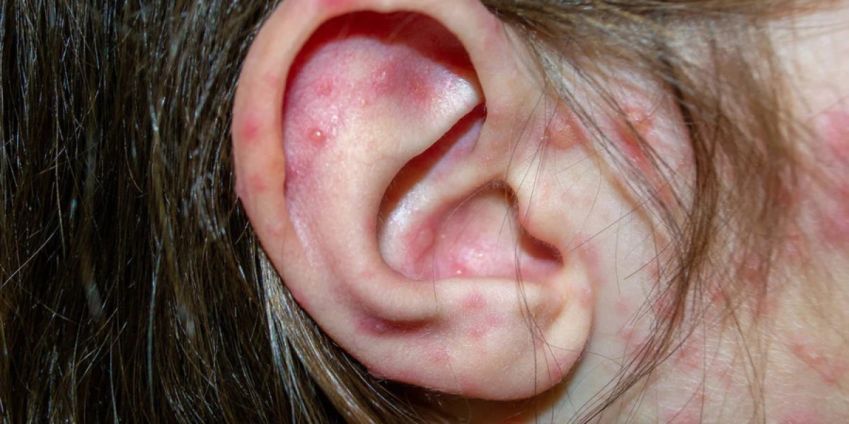 Navigating Ear Eczema: Expert Tips for Soothing and Prevention