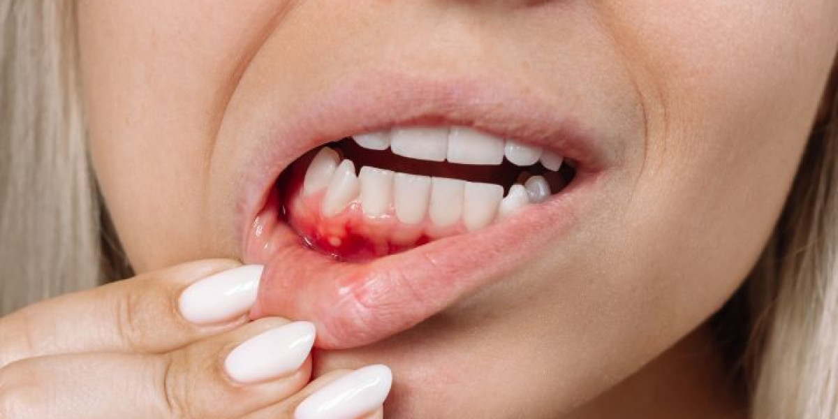 What Are the Common Causes of a Hole in Gum and How to Prevent It?