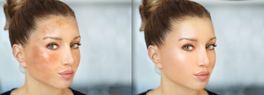 Hyperpigmentation UK Cover Image