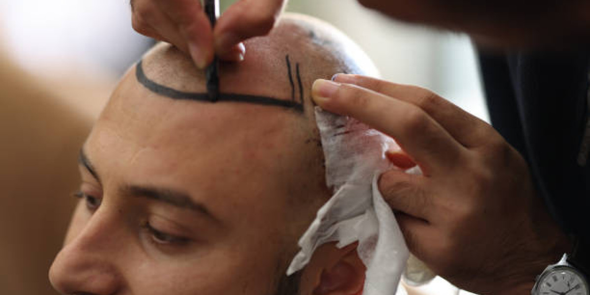 How Do Surgeons Design a Natural-Looking Hairline?