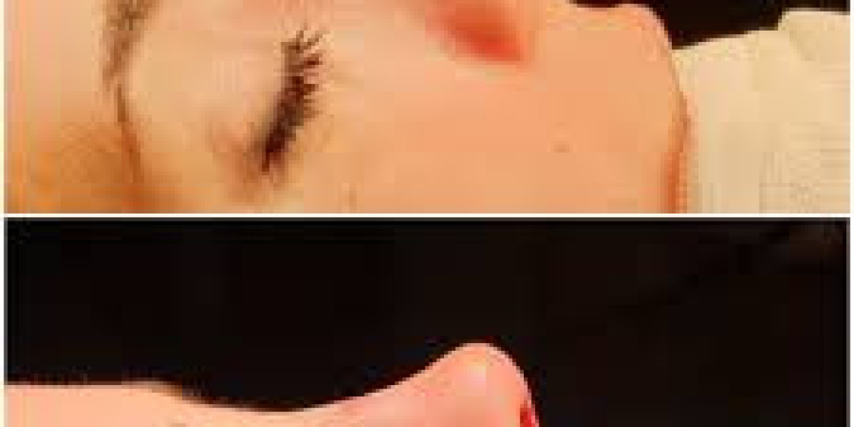 Nasenkorrektur in Düsseldorf – Natürlich schön mit Diamond Aesthetics