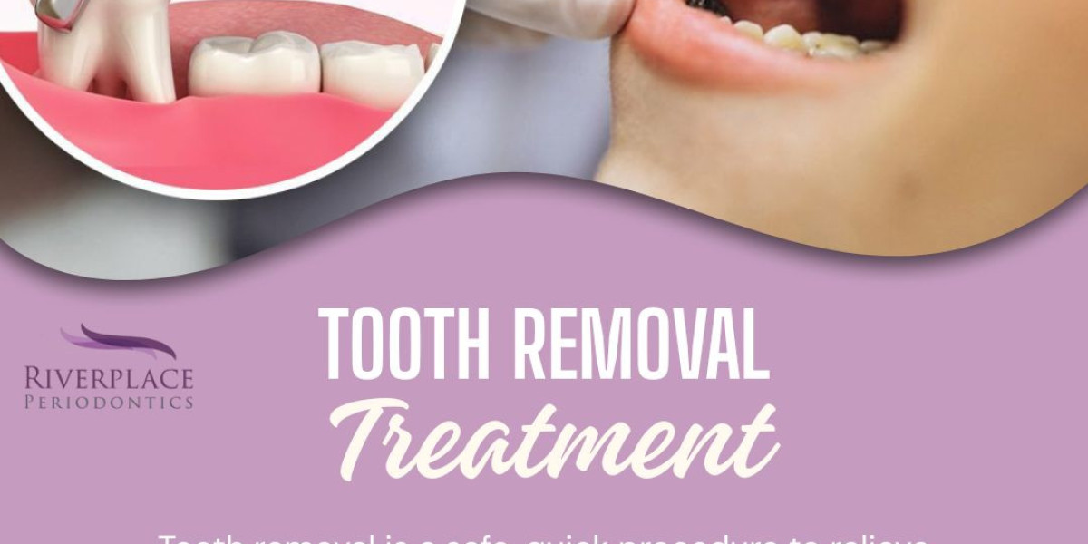 Everything You Need to Know About Tooth Removal
