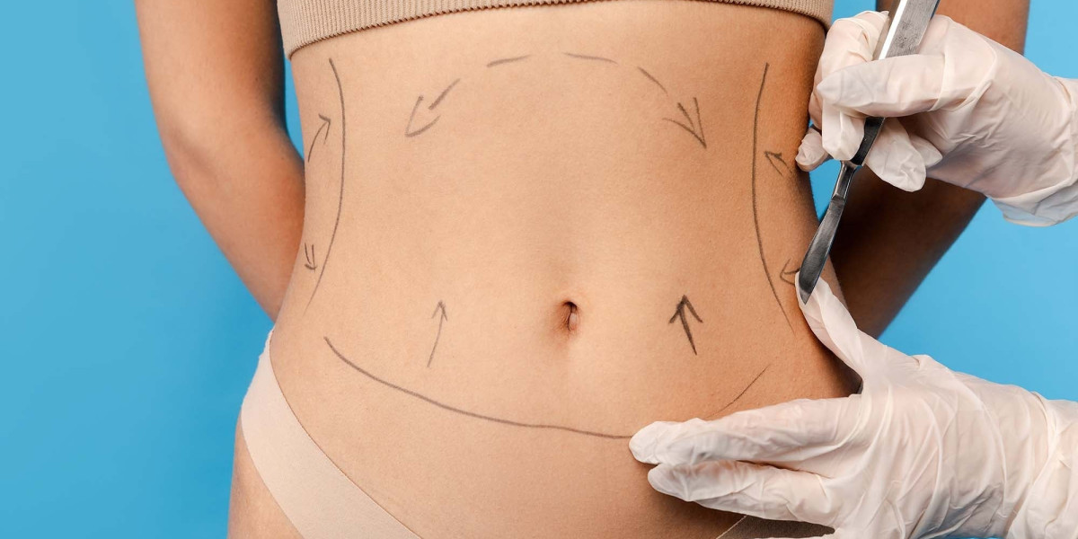 Liposuction in Riyadh: What Makes It Different