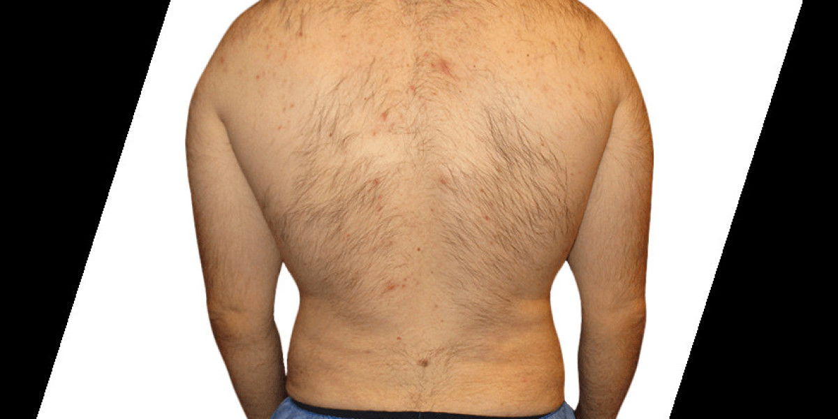 How Long Do Results from Smart Liposuction Houston Really Last