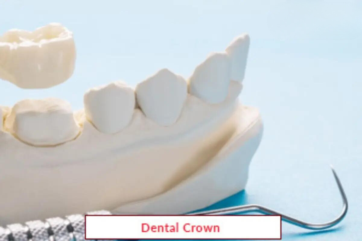 Dental Crown Treatment | Procedure & Benefits