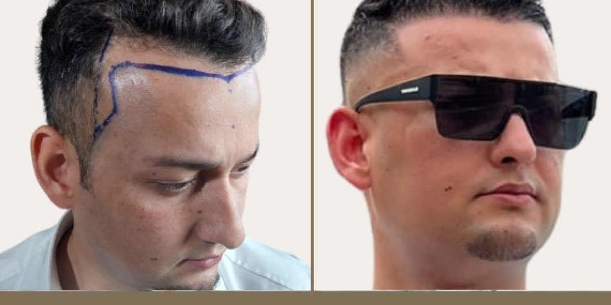 Unveiling the Transformation: A Comprehensive Guide to Hair Transplant in Islamabad